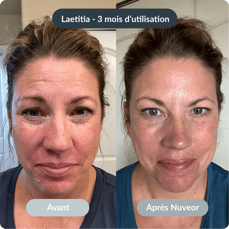 NUVEOR™ | Micro-Infusion Active Anti-Âge