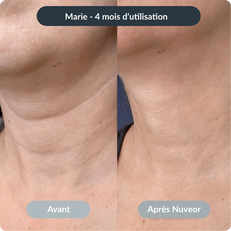 NUVEOR™ | Micro-Infusion Active Anti-Âge