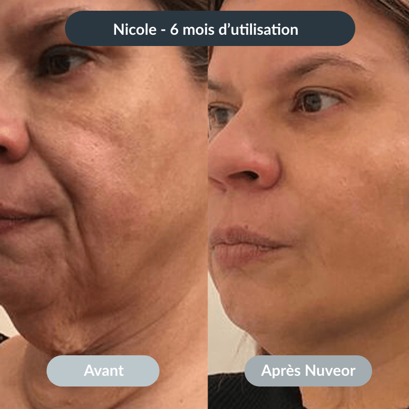 NUVEOR™ | Micro-Infusion Active Anti-Âge