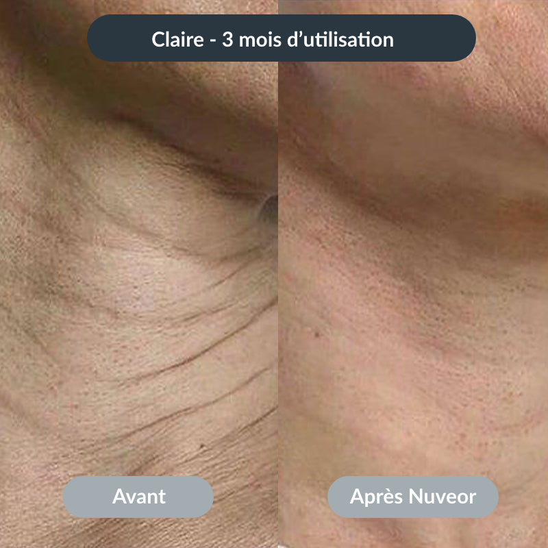NUVEOR™ | Micro-Infusion Active Anti-Âge